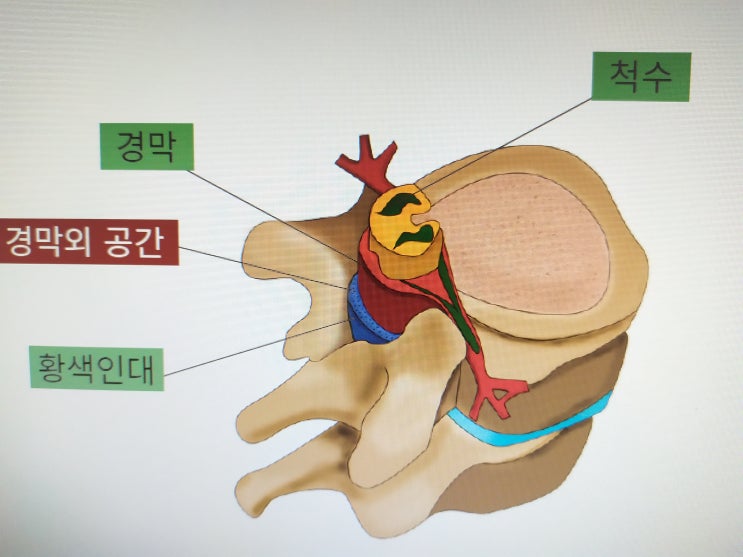 허리통증 완화, 허리디스크 등 척주질환의 주사 치료