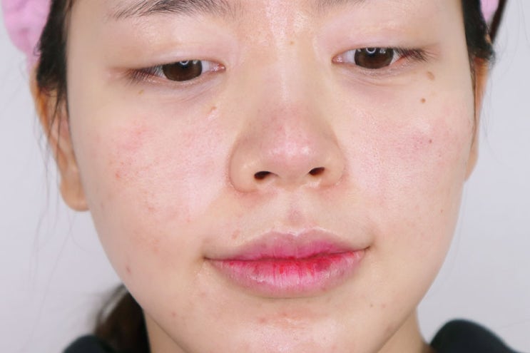  얼굴 여드름 흉터 중에서도 가장 효과 봤던 방법