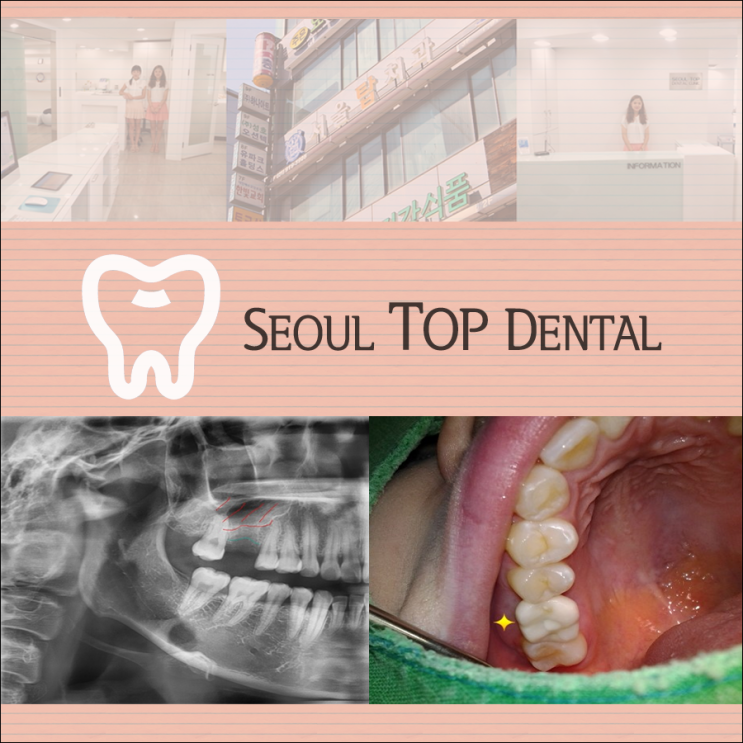  일산치과추천 임플란트 미루지 마세요