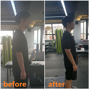  성신여대PT 거북목증후군 및 일자목 개선하기!!