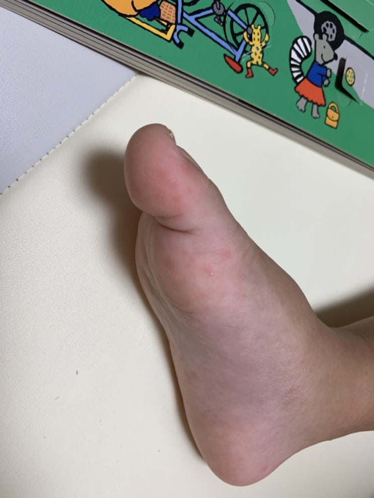  [수족구 뒷북]수족구와 농가진이 동시에 ... 환장콜라보...(스압)