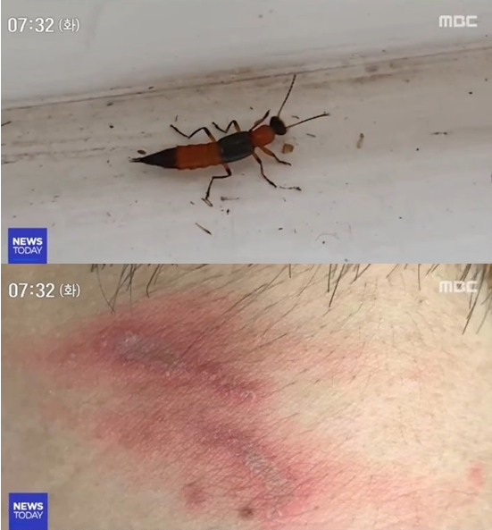  화상벌레, 닿기만 해도 화상··· 대학 기숙사 덮쳐 침대까지 올라와