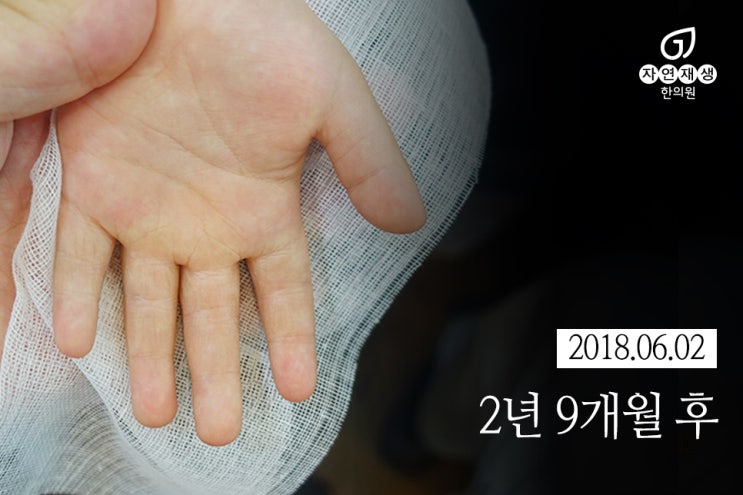  어린이화상! 응급처치 시 유의할점과 한의학적 치료방법