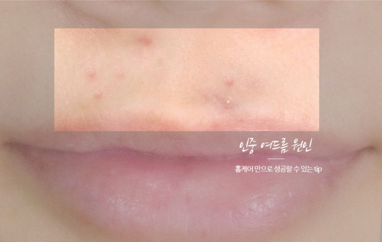  인중 여드름 원인 알고나서 빠르게 응급처치한 비법