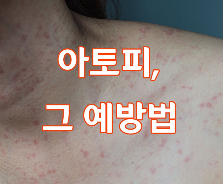  아토피와 그 예방법