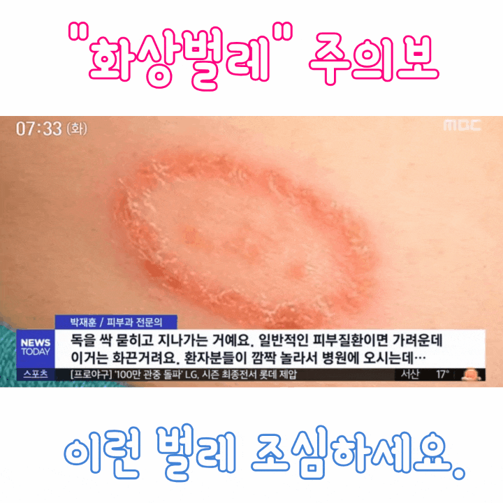  화상벌레 주의보 독충 청딱지개미반날개에 물렸을때 대처법