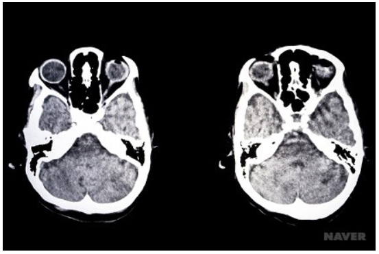 CT,MRI, MRA 차이점이 뭔가요? CT촬영 MRI 검사 비용 : 네이버 블로그
