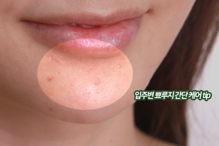  입주변 뾰루지 핵심만 정리한 간단 케어tip