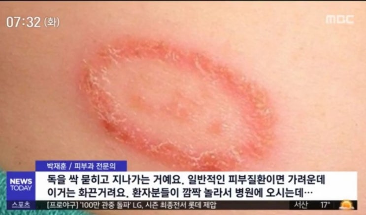  대학 기숙사 닿기만해도 상처나는 '화상벌레' 우리집에도..?