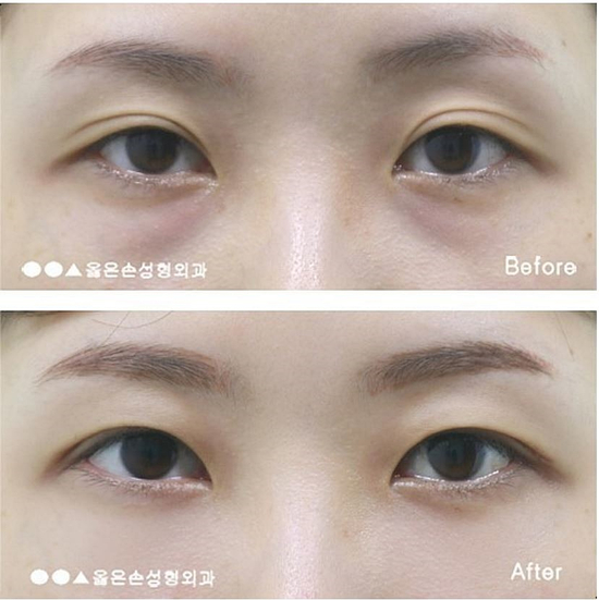  눈밑지방재배치수술비용 여기서 해결