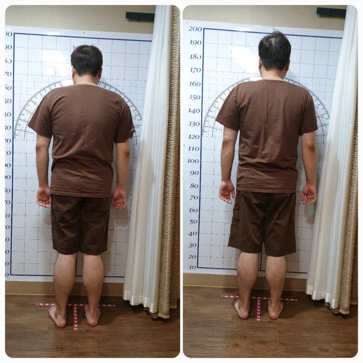 굽은 등 어깨 체형교정