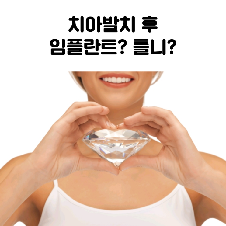  대학로 임플란트치과 치아발치 후 임플란트? 틀니?