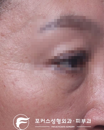 [부천성형외과 Dr. 김 칼럼] 눈밑꺼진 곳에 눈밑필러