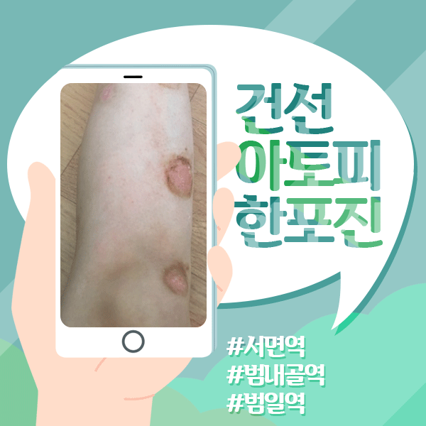  건선질환을 앓고있다면 주의해야 할 [건선관절염]