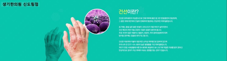  건선 방치하시면 만성으로