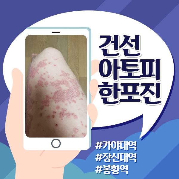  환절기 두드러기 습진 및 난치성 피부질환에는 면역력강화가 답!