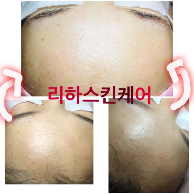  관악구 동작구 서울대입구 봉천역 숭실대입구 상도역 여드름 전후사진 리하스킨케어