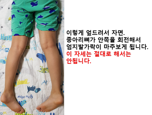  안짱다리병원에서 알려주는 소아안짱다리