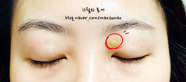  비립종을 제거했다