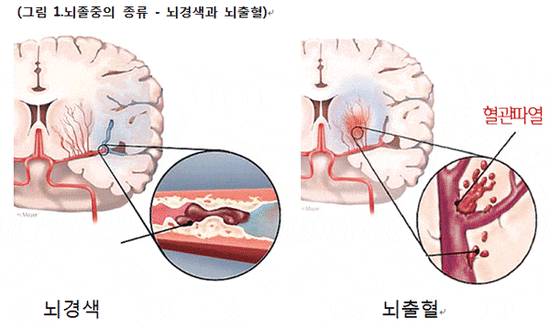수원재활요양병원 : 뇌졸중(뇌경색,뇌출혈) 환자의 재활치료