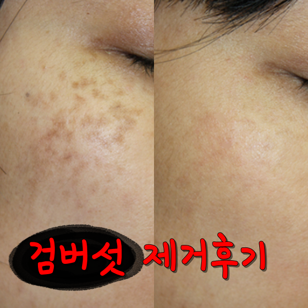  검버섯 제거 비용X 집에서 없애기(한달)