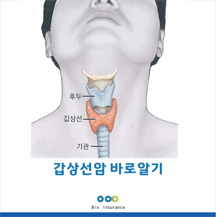  갑상선암 단계 별 진단과 치료