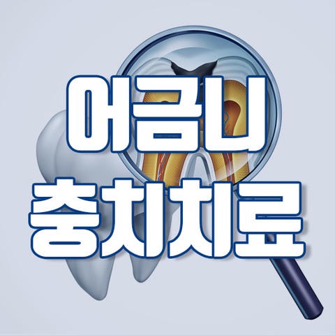  어금니충치치료 충치 진행에 따른 치료선택 및 고려사항