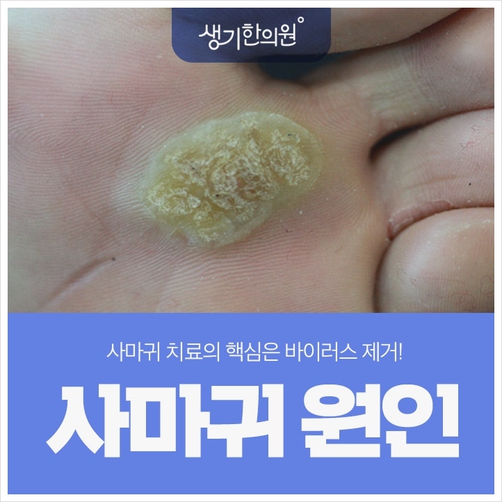  인천사마귀 왜 발생하는 건가요?
