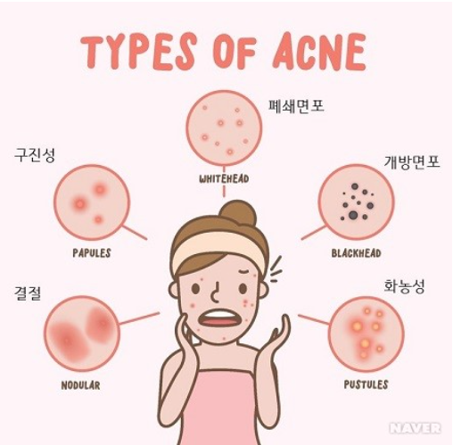  사춘기 여드름 관리는 어떻게 하나요?