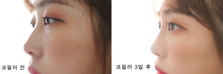  코필러후기 바로 코가생겼어요. 6일차 모습까지!