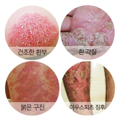  무서운 대구건선, 함께 알아보자!
