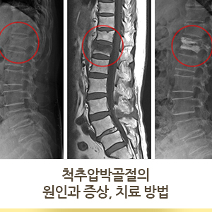 충격으로 허리 통증이 발생했다면 척추압박골절을 의심해 볼 수 있습니다. [심정병원]