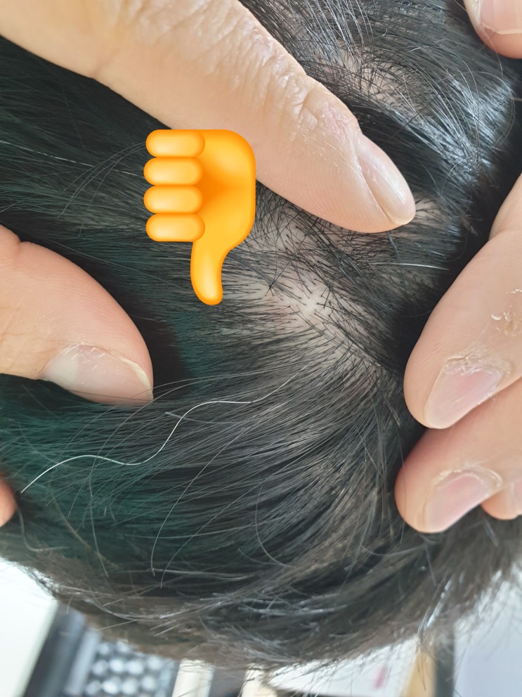  머리에 뾰루지 나거나 두피 발진 나면 당장 바꿔야하는 것