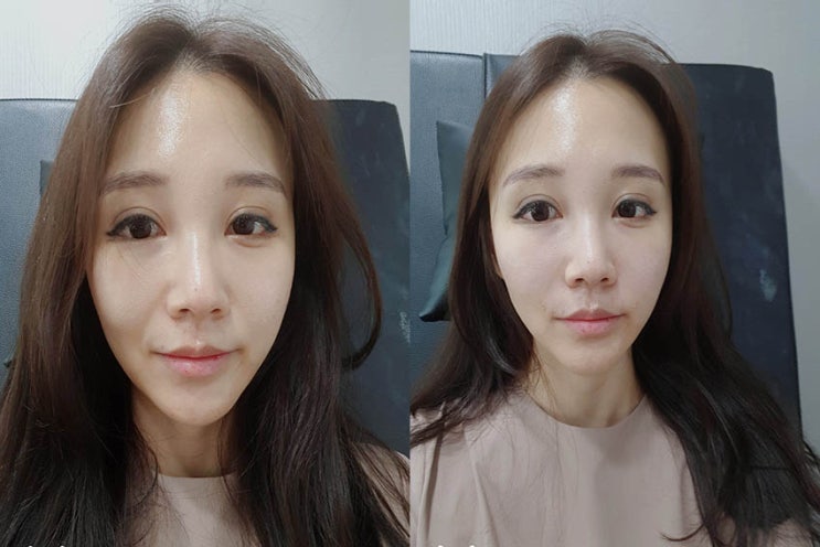  팔자주름필러 맞고왔어요 !! 잠실새내피부과에서 제돈주고 맞고온 리얼후기로 팔자필러 궁금하신분들 보셔용 !!!!!!!!!! :)