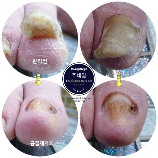 깍을수없이 두꺼워진 할아버지의 무좀발톱/분당용인수원수지보정동백죽전동/주네일/무좀파고드는내향성발톱전문네일샵 깍을수없이 두꺼워진 할아버지의 무좀발톱/분당용인수원수지보정동백죽전동/주네일/무좀파고드는내향성발톱전문네일샵