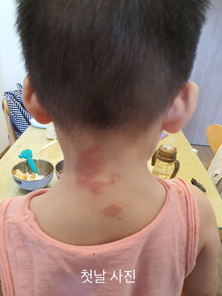  [베트남 여행]아이가 화상벌레에 물렸어요..