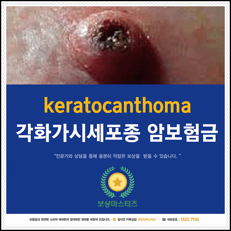  각화가시세포종 keratocanthoma 암보험금 후련하게!
