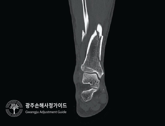  [광주손해사정] 발목골절로 인한 후유장해 보험금 보상 받기! : 광주손해사정가이드 장한서 손해사정사