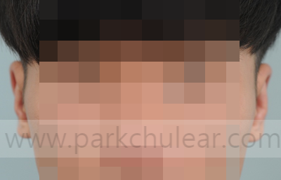  돌출귀 (원숭이귀, 당나귀귀) 의 귀성형 방법, 알려주세요 - 2