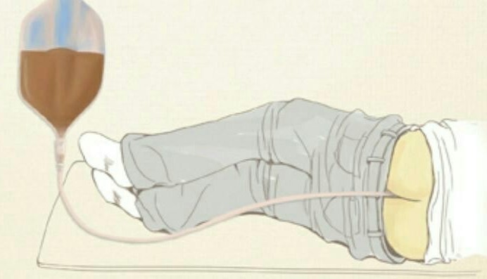  해독요법 ㅡ 커피관장