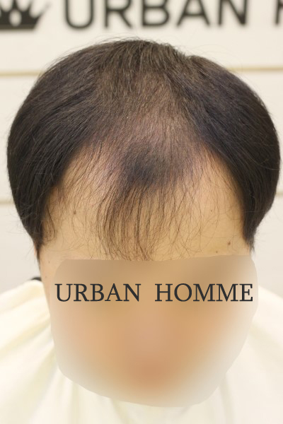  가을 계절 남자 탈모 헤어스타일 저도 커버펌 했어요