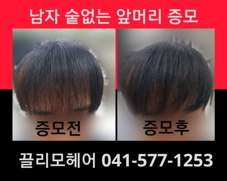  천안모발이식 이젠 헤어증모로 하세요