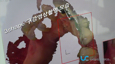  치아 색이라 보기좋아 포세린 크라운가격 저렴하여 많이 사용하죠 그런데 앞니에 단점도