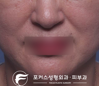  [부천성형외과 Dr.김 칼럼] 부천필러 - 팔자주름엔 팔자필러?