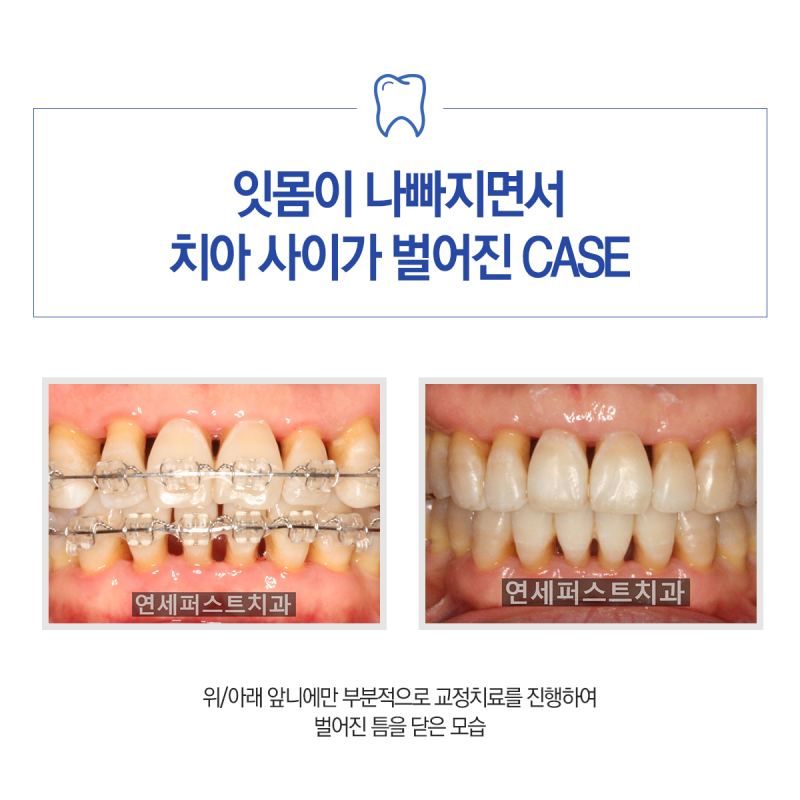 ●치아교정과 이중수술 중 어느 쪽을 먼저 해야 할지 부천치아교정