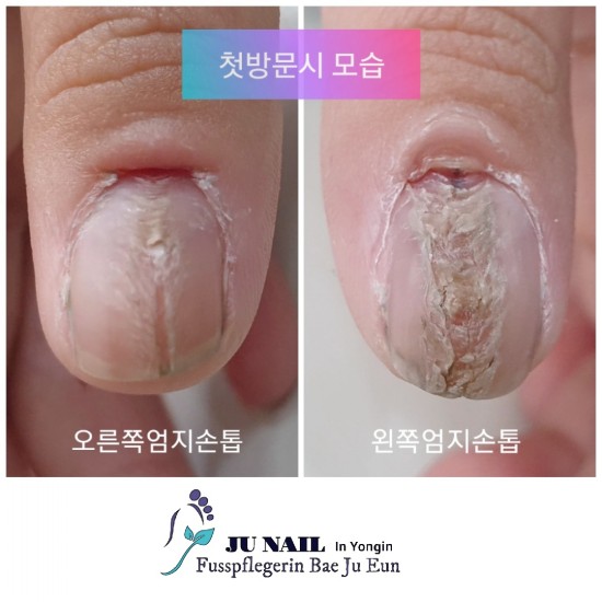 일산에서 오셨어요. 8세여아의 손톱가운데가 파여버리도록 뜯는버린 무서운습관 고쳐보아요/분당용인수원수지보정동백죽전동/주네일/무좀파고드는내향성발톱손톱변형전문네일샵 일산에서 오셨어요. 8세여아의 손톱가운데가 파여버리도록 뜯는버린 무서운습관 고쳐보아요/분당용인수원수지보정동백죽전동/주네일/무좀파고드는내향성발톱손톱변형전문네일샵