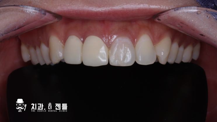  [앞니 치료 전문치과 / 치과더젠틀] 자전거 라이딩 중 넘어져서 부러지고 변색된 앞니의 E-max 올세라믹 크라운 치료 증례.