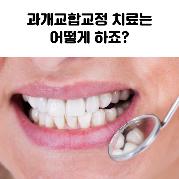  대학로 이물비치과 과개교합교정 치료는 어떻게 하죠?