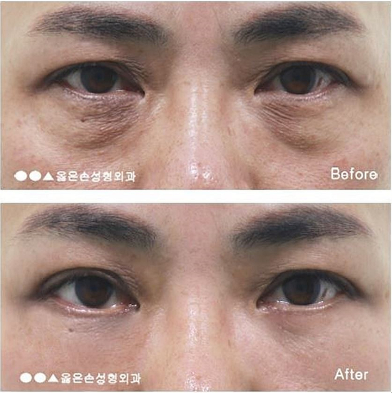  눈밑지방제거수술비용 만족해요