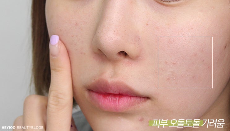  피부 오돌토돌 가려움 원인 모낭충때문이라고?